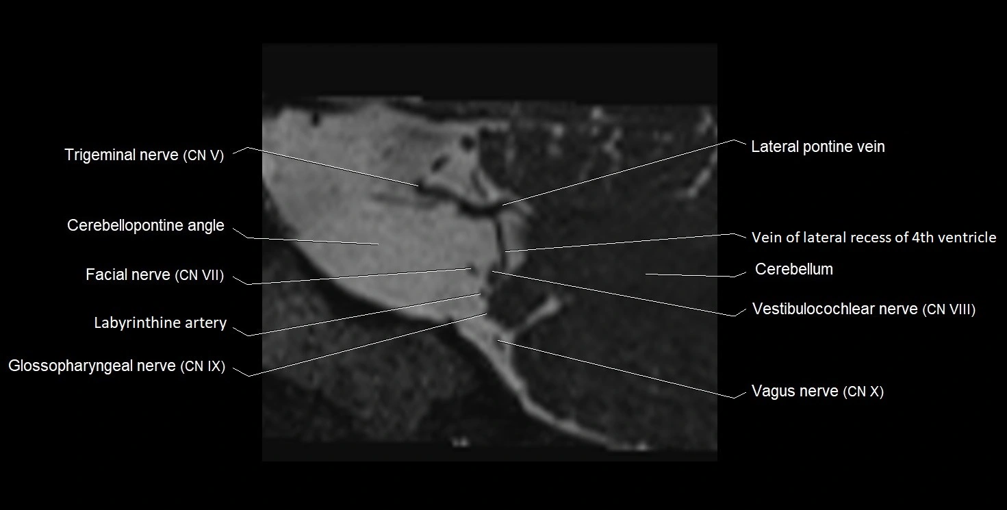 Internal auditory meatus (IAM) 3T sagittal cross sectional anatomy image 40.webp